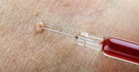 How The Mmr Injection Can Banish Unsightly Warts The Irish News