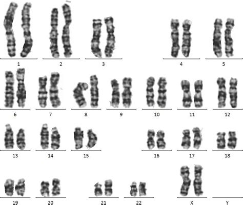 Karyotyping Of The Cells From Twin B A Karyotype Of 46 Xx 21 Der