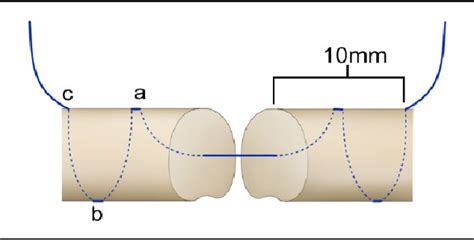 Figure 2 From A Knotless Bidirectional Barbed Tendon Repair Is Inferior