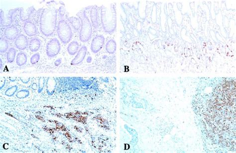 Histidine Decarboxylase Expression As A New Sensitive And Specific