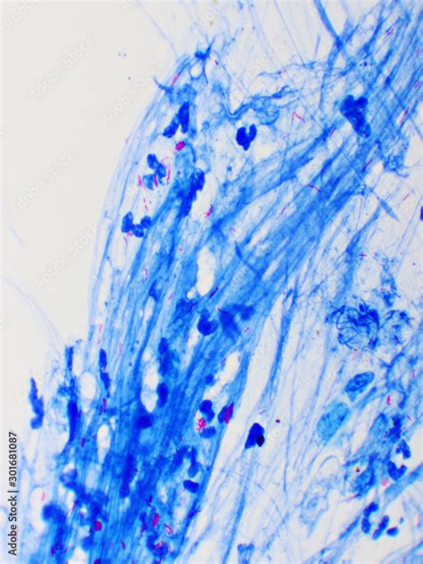 Mycobacterium Tuberculosis Positive Small Red Rod In Sputum Smear Acid Fast Stain Analyze By