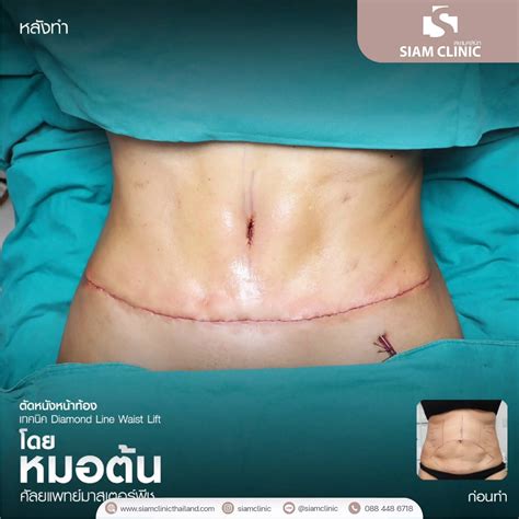 Tummy Tuck Surgery Siam Clinic Aesthetic Wellness Clinic In Phuket