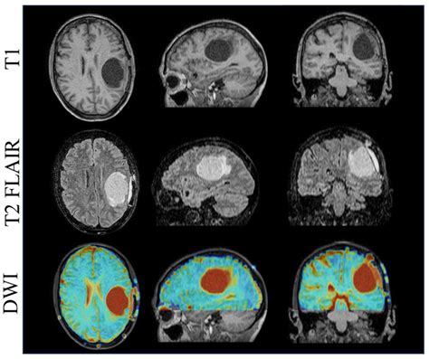 T1 Top T2 FLAIR Center And DWI Bottom Imaging 1 5T MR Linac