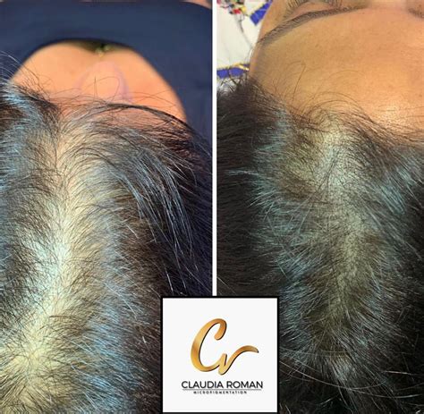 Scalp Micropigmentation | Micropigmentation Center of Miami