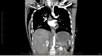 Double Rib Sign On Computed Tomography Of The Chest Indication For