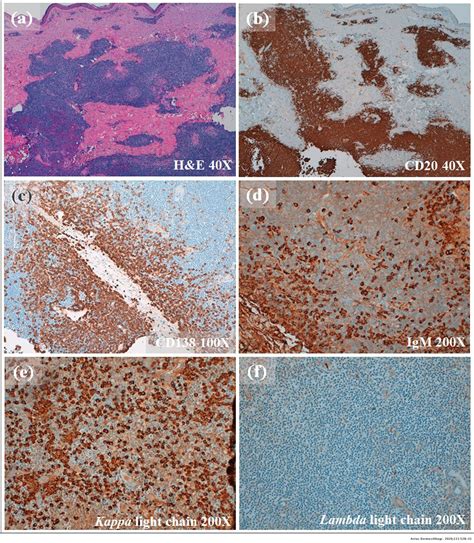 Infiltración Neoplásica Cutánea Por Un Linfoma Linfoplasmocítico En Una