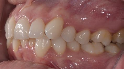 Lower Incisor Extraction Case — E Line Orthodontics