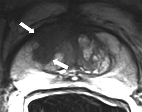 Transition Zone Prostate Cancer Detection And Localization With 3 T