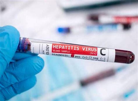 Colombia Detecta Primer Caso De Hepatitis Aguda De Origen Desconocido