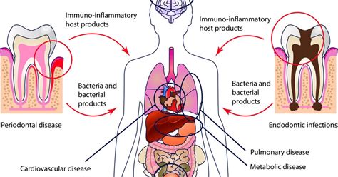 Periodontitis And Systemic Conditions − Is There A Link Healthy Dent