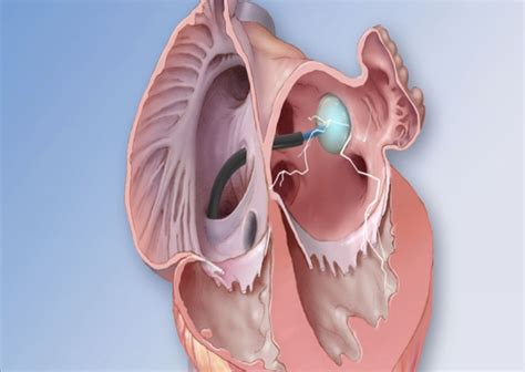 Aubmc Cardiac Electrophysiology Team Performs A Novel Procedure Using A Cryoballoon