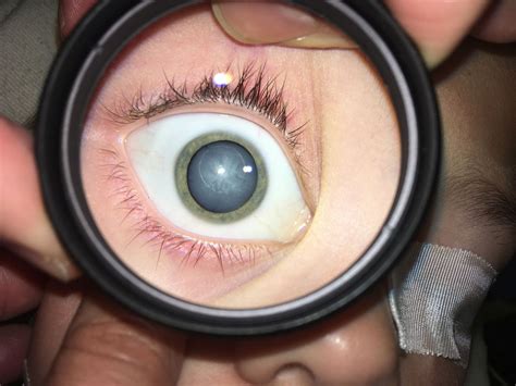 Diabetes Cataract In A 10 Year Old Girl With New Onset Type 1 Diabetes