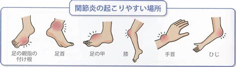 高尿酸血症を放っておくと起こる「痛風」について 医療法人神楽岡泌尿器科