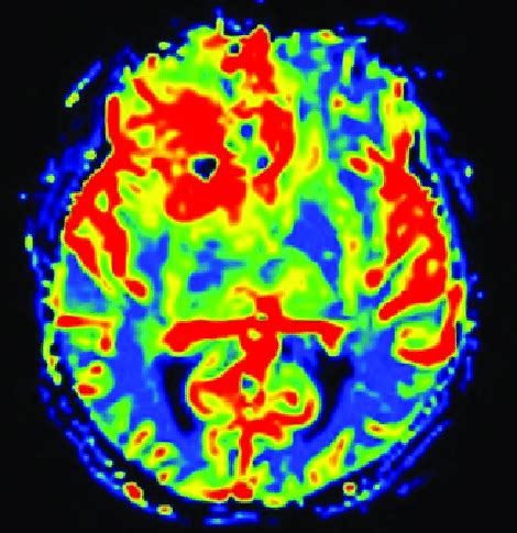 Dynamic Susceptibility Contrast DSC Perfusion Weighted Image There