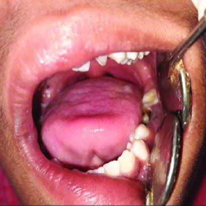 Nonrestorable Grossly Carious Left Permanent Mandibular First Molar