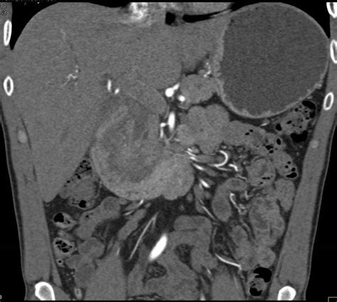 Groove Pancreatitis Pancreas Case Studies Ctisus Ct Scanning
