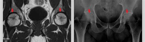 Avascular Necrosis As A Part Of Long COVID 19 BMJ Case Reports