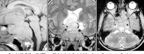 Figure 1 From Giant Pituitary Adenoma Invading The Clivus Semantic