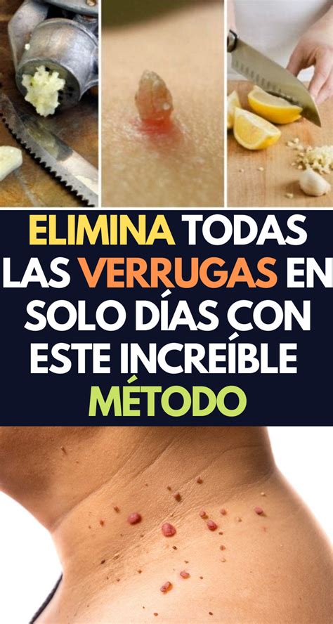 ELIMINA LAS VERRUGAS EN SOLO DÍAS CON ESTE INCREÍBLE MÉTODO Verrugas