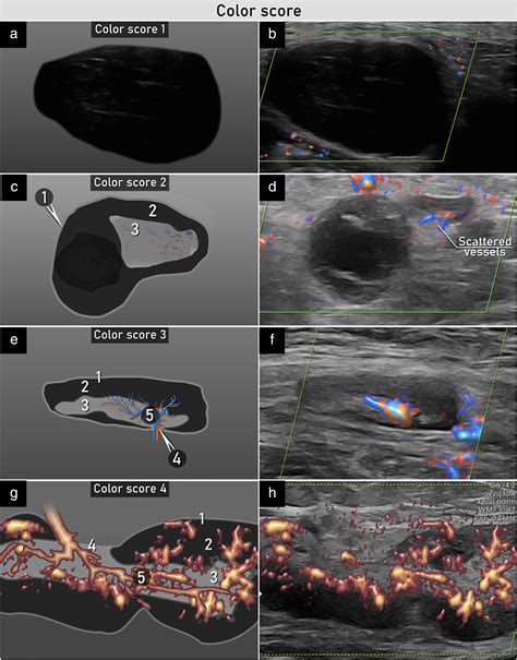 Terms Definitions And Measurements To Describe Sonographic Features Of