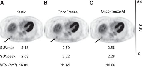 Evaluation Of Data Driven Respiration Gating In Continuous Bed Motion