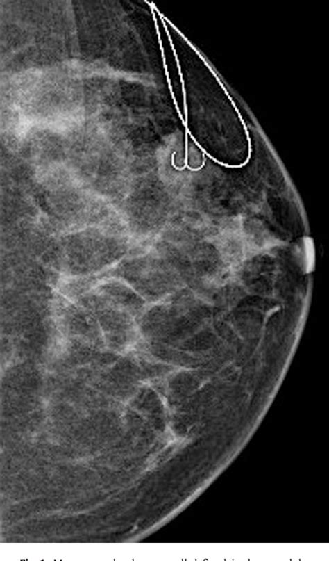 Figure From Malignant Eccrine Breast Spiradenoma A Case Report And