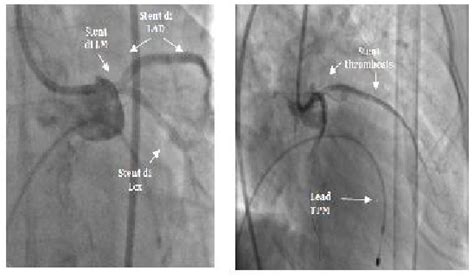 (left) stent mounted on the proximal Cx, LMCA-mid proximal LAD. (Right)... | Download Scientific ...