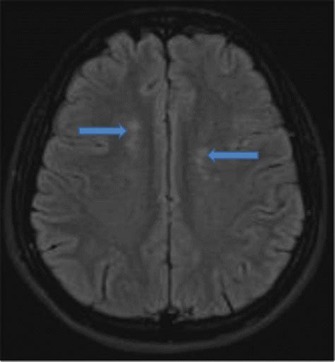 Mri Brain Shows Extensive Bilateral Symmetrical Punctuate Foci Of