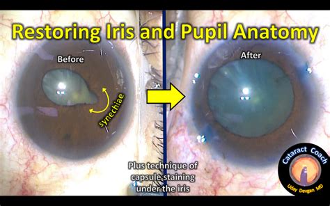 Lysis Of Synechiae And Capsule Staining Under Iris Cataract Coach