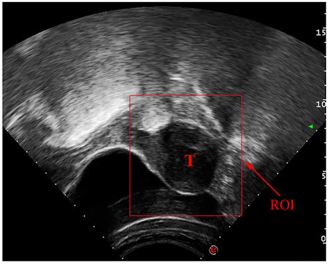 Uterus Fibroids Ultrasound