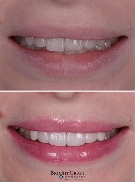 Smile Gallery Best Dentist Dental Implant Services In Burbank Ca