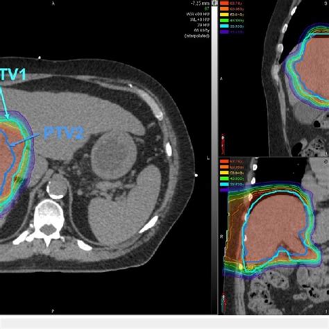 Intensity Modulated Proton Therapy With Simultaneous Integrated Boost Download Scientific