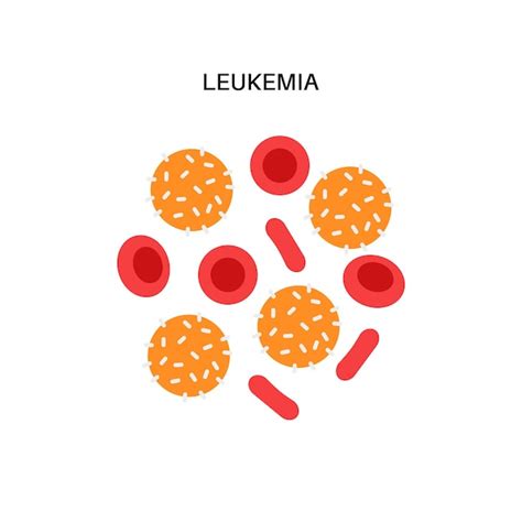 Spécimen Atteint De Leucémie Notion De Cancer Du Sang Structure Des Cellules Sanguines