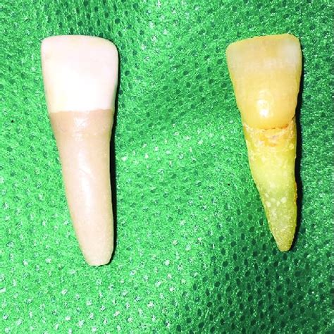 Maxillary Central Incisor Labial View Download Scientific Diagram