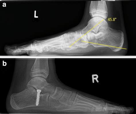 Radiographs. a The talo-calcanear angle in a flatfoot. b Implemented ...