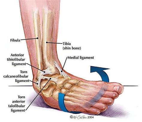 Ankle Sprain In Singapore Things You Need To Know Orthocare Sg