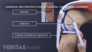 Lateral Collateral Ligament (LCL) Definition | Sports Injury-Related ...