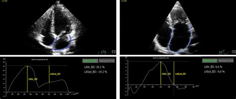 The Figure Presents The Strain Of The Left Atrium Using Two Dimensional