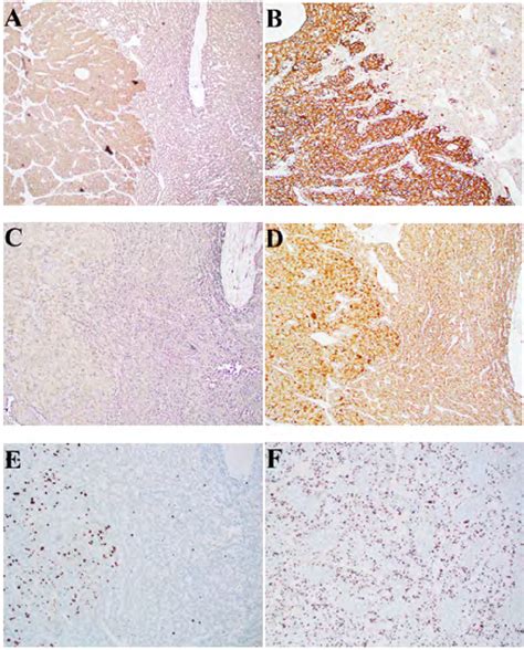 Tumor Cells Display A Positive Ae Ae B Positive Cd C Positive