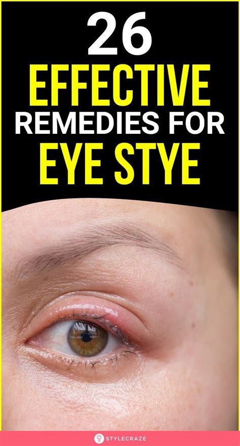 How To Get Rid Of A Stye 26 Home Remedies And Precautions Artofit