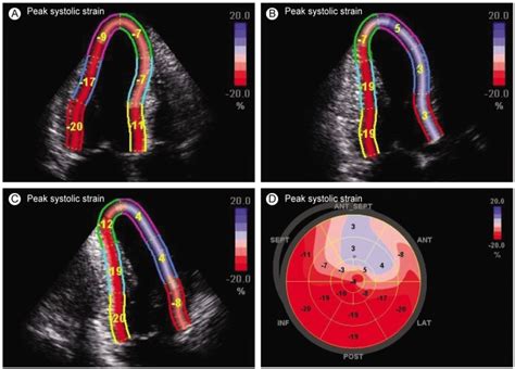 Representative Example Of The Measurement Of Peak Systolic Strain By