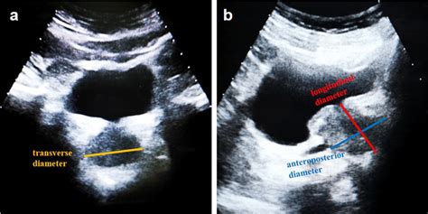 Measurement Of Prostate Diameter When Using Ellipsoid Formula To Download Scientific Diagram