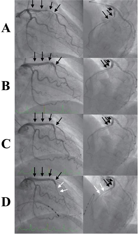 Figure From Chest Pain Without Significant Coronary Stenosis After