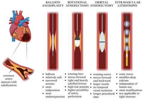 Jcm Free Full Text Rotational Atherectomy Orbital Atherectomy And