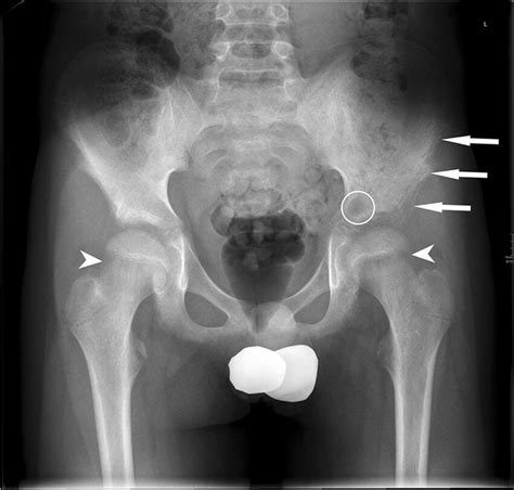 Anteroposterior Radiograph Of The Pelvis In A Year Old Boy With A