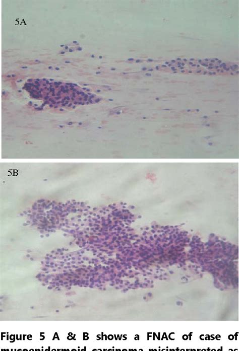 Figure From Pitfalls In Salivary Gland Fine Needle Aspiration