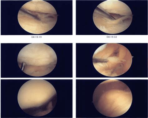 Case Study Knee Arthroscopy Medial Meniscectomy With Femoral