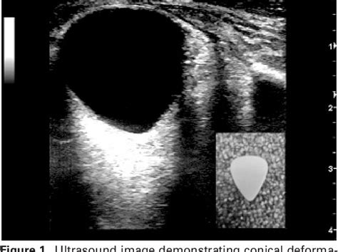 Figure 1 From The Guitar Pick Sign A Novel Sign Of Retrobulbar Hemorrhage Semantic Scholar