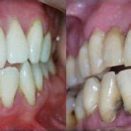 Tratamento Para Gengivite Periodontite Em C Proc Pio Dr Andr Pimenta