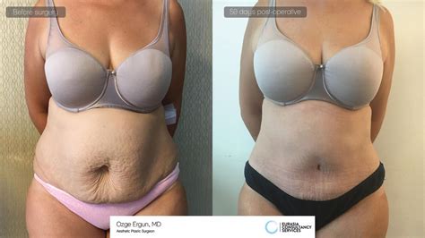 Abdominoplastia Plastic Surgery Before And After Photos